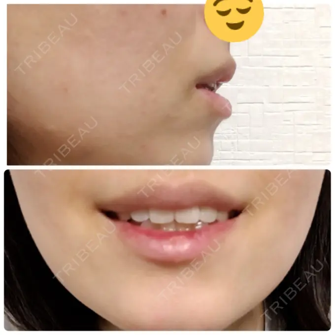 口唇縮小術 品川スキンクリニック表参道院 DAY 30 メイン用