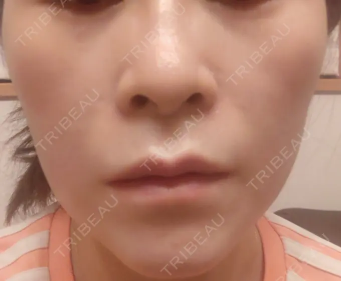 ボトックス（エラ・小顔） 新宿TAクリニック DAY 8 メイン用