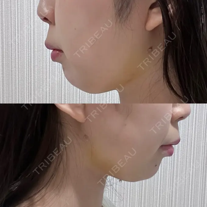 糸リフト / 脂肪吸引（顔） / 脂肪吸引注射（顔） ziz CLINIC DAY 7 メイン用