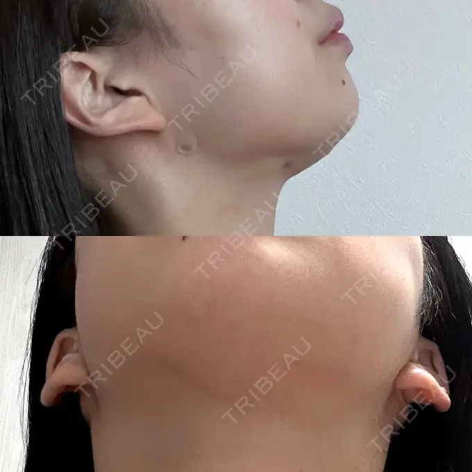 糸リフト / 脂肪吸引（顔） / 脂肪吸引注射（顔） ziz CLINIC DAY 13 メイン用