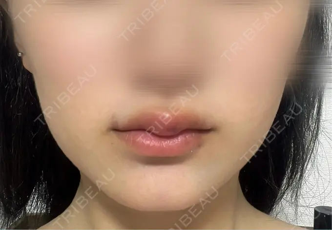 ヒアルロン酸注入（唇） アリエル美容クリニック 横浜院 DAY 4 メイン用