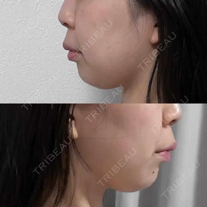 糸リフト / 脂肪吸引（顔） / 脂肪吸引注射（顔） ziz CLINIC AFTER メイン用