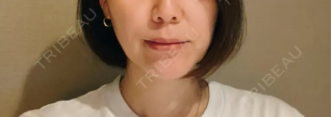 ヒアルロン酸注入（唇） / ヒアルロン酸注入（目の下） アリエル美容クリニック 横浜院 DAY 3 メイン用