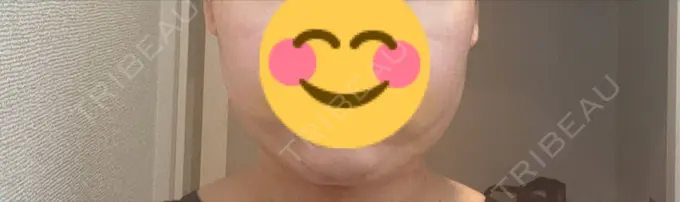 糸リフト / バッカルファット除去 / 脂肪吸引（顔） アリエル美容クリニック 横浜院 DAY 5 メイン用