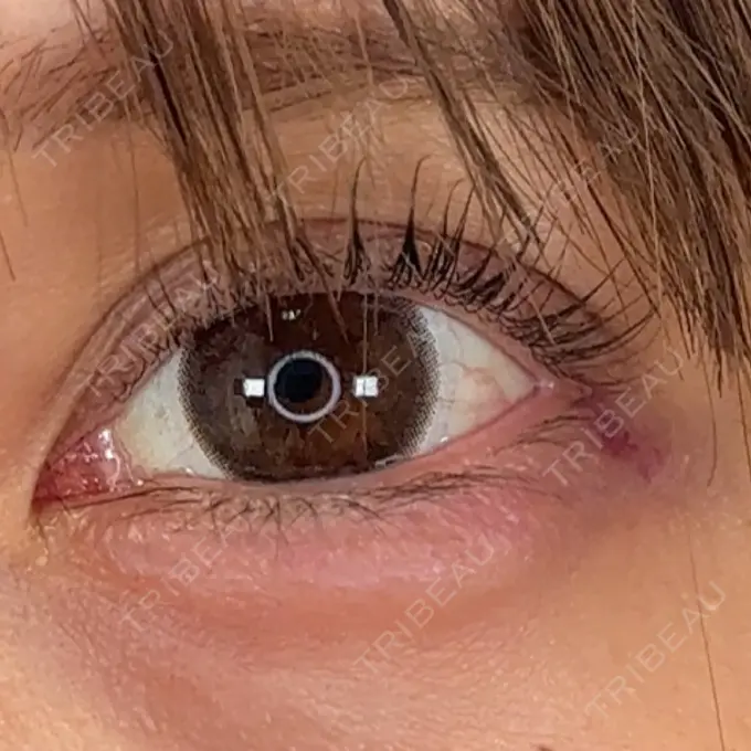 ヒアルロン酸注入（涙袋） アリエル美容クリニック 横浜院 DAY 1 メイン用