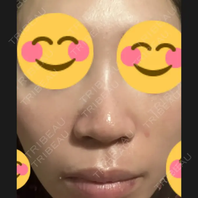 プラセンタ注射 / その他（肌） 美容皮膚科エルムクリニック 麻布院 DAY 4 メイン用