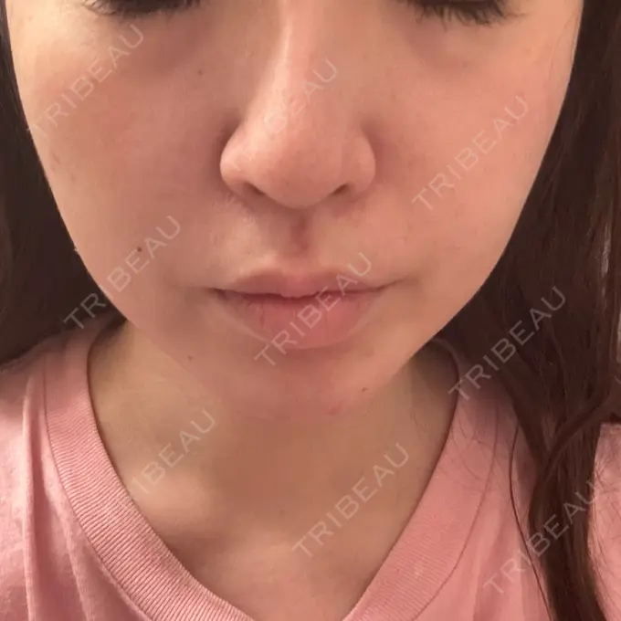 インディバ（顔） Casa de GRACIA GINZA 【カーサデグラシアギンザ】 AFTER メイン用