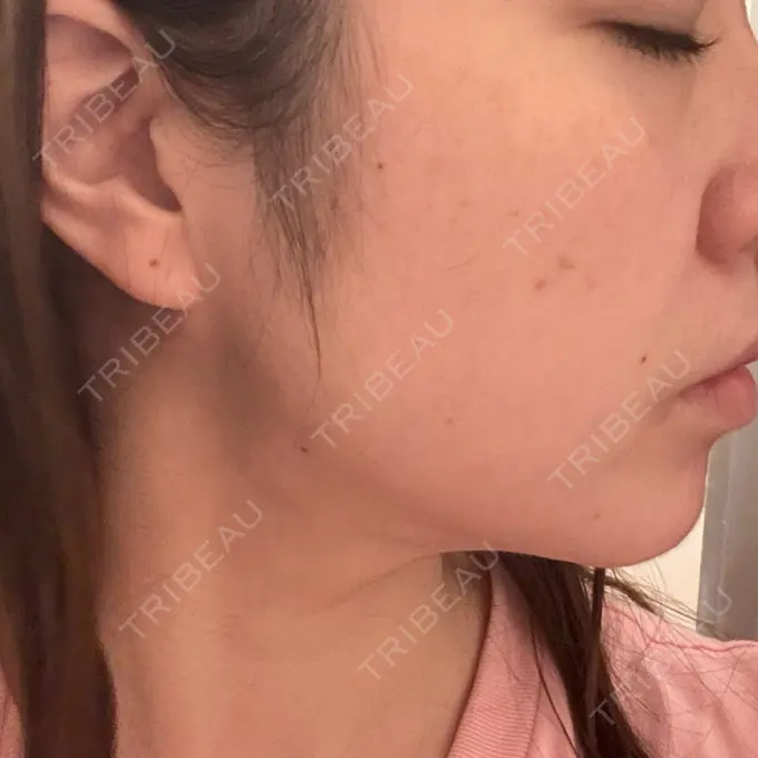 インディバ（顔） Casa de GRACIA GINZA 【カーサデグラシアギンザ】 DAY 45 メイン用