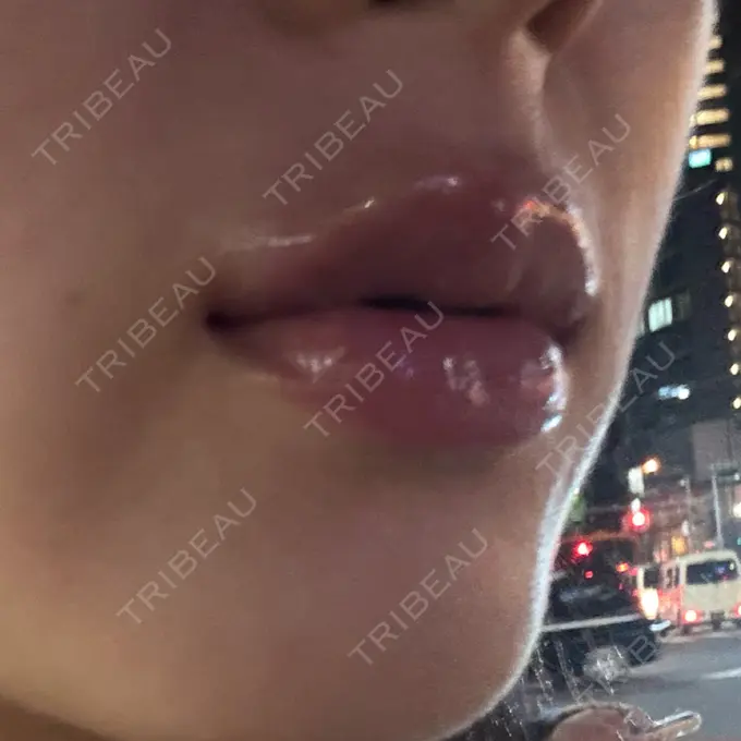 ヒアルロン酸注入（唇） / その他（口元） 銀座美容外科クリニック 銀座院 DAY 0 メイン用