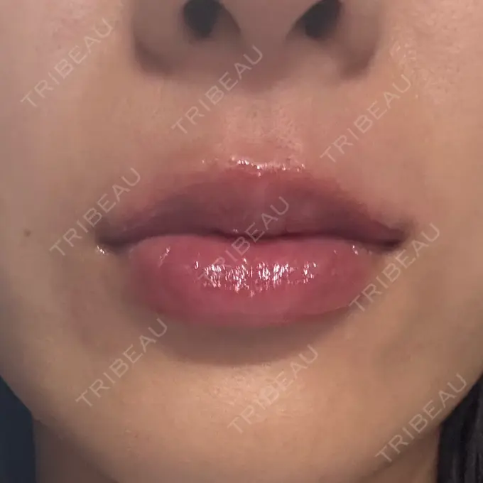 ヒアルロン酸注入（唇） / その他（口元） 銀座美容外科クリニック 銀座院 DAY 0 メイン用