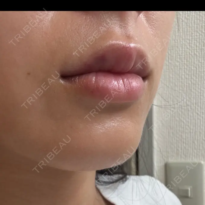 ヒアルロン酸注入（唇） / その他（口元） 銀座美容外科クリニック 銀座院 DAY 0 メイン用