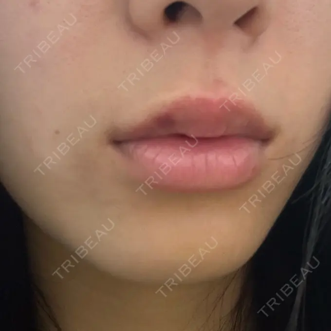 ヒアルロン酸注入（唇） / その他（口元） 銀座美容外科クリニック 銀座院 DAY 1 メイン用