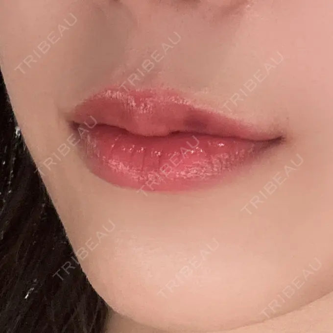 ヒアルロン酸注入（唇） / その他（口元） 銀座美容外科クリニック 銀座院 DAY 2 メイン用