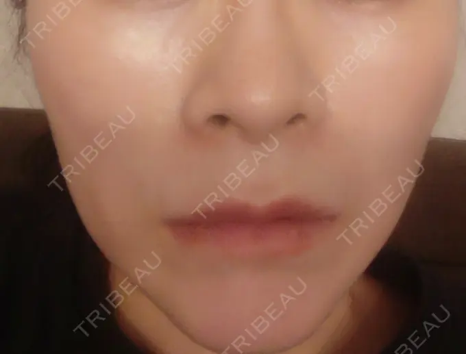 ボトックス（エラ・小顔） 新宿TAクリニック DAY 9 メイン用