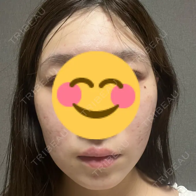 糸リフト / 脂肪吸引（顔） / ボトックス（エラ・小顔） RIVER CLINIC（リバークリニック） AFTER メイン用