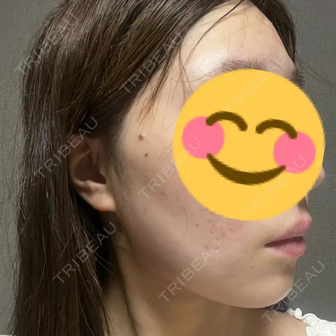 糸リフト / 脂肪吸引（顔） / ボトックス（エラ・小顔） RIVER CLINIC（リバークリニック） DAY 0 メイン用