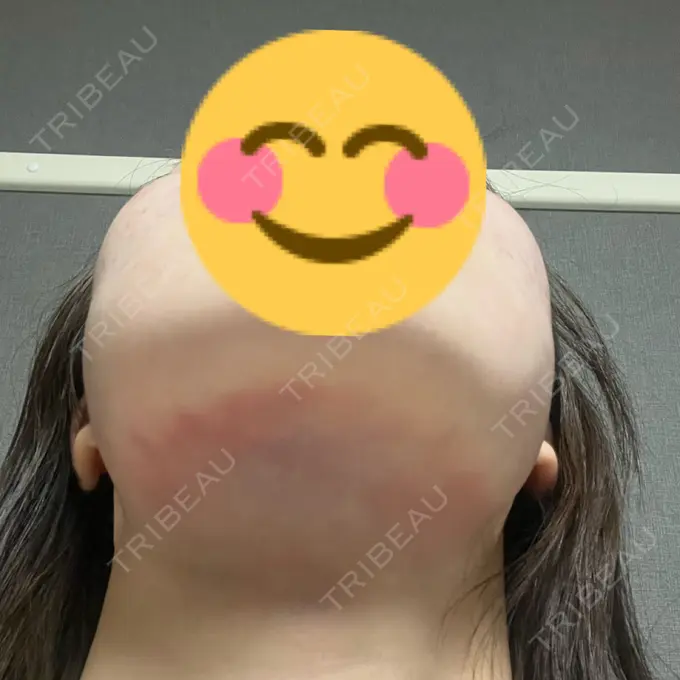 糸リフト / 脂肪吸引（顔） / ボトックス（エラ・小顔） RIVER CLINIC（リバークリニック） DAY 0 メイン用