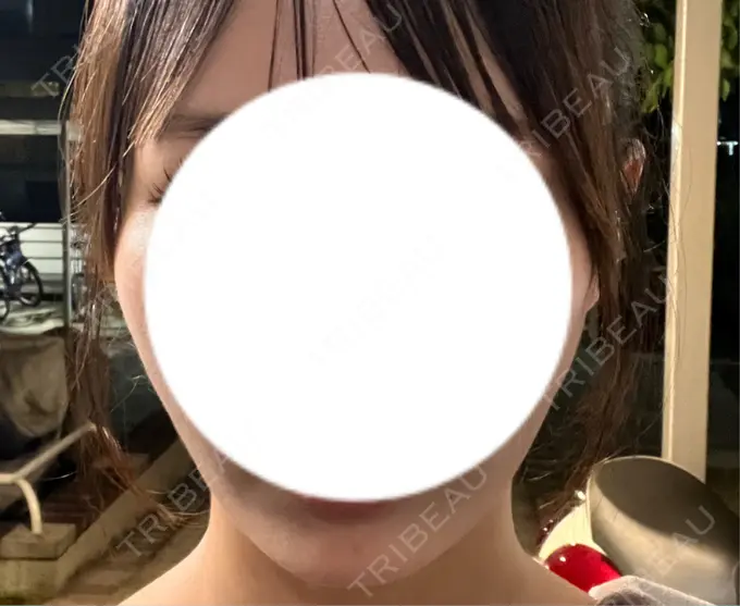 糸リフト / その他（肌） MAクリニック 心斎橋 DAY 3 メイン用