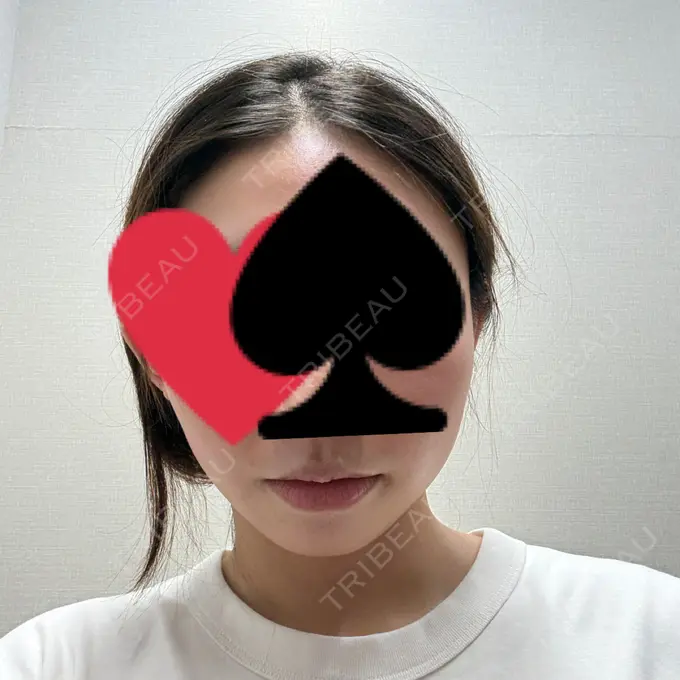 ハイフ（顔） 東京美容外科 池袋院 DAY 0 メイン用