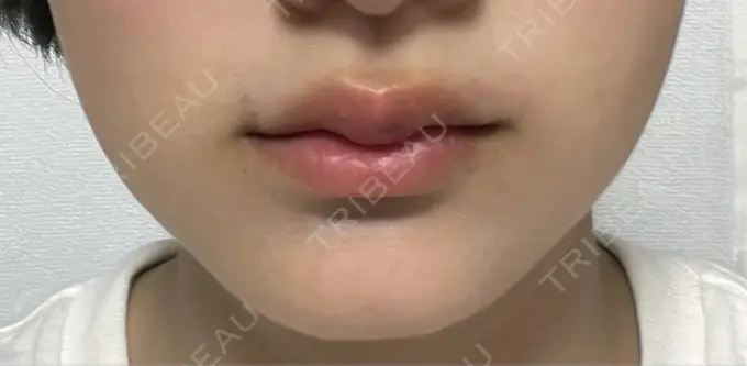 ヒアルロン酸注入（唇） アリエル美容クリニック 横浜院 DAY 5 メイン用