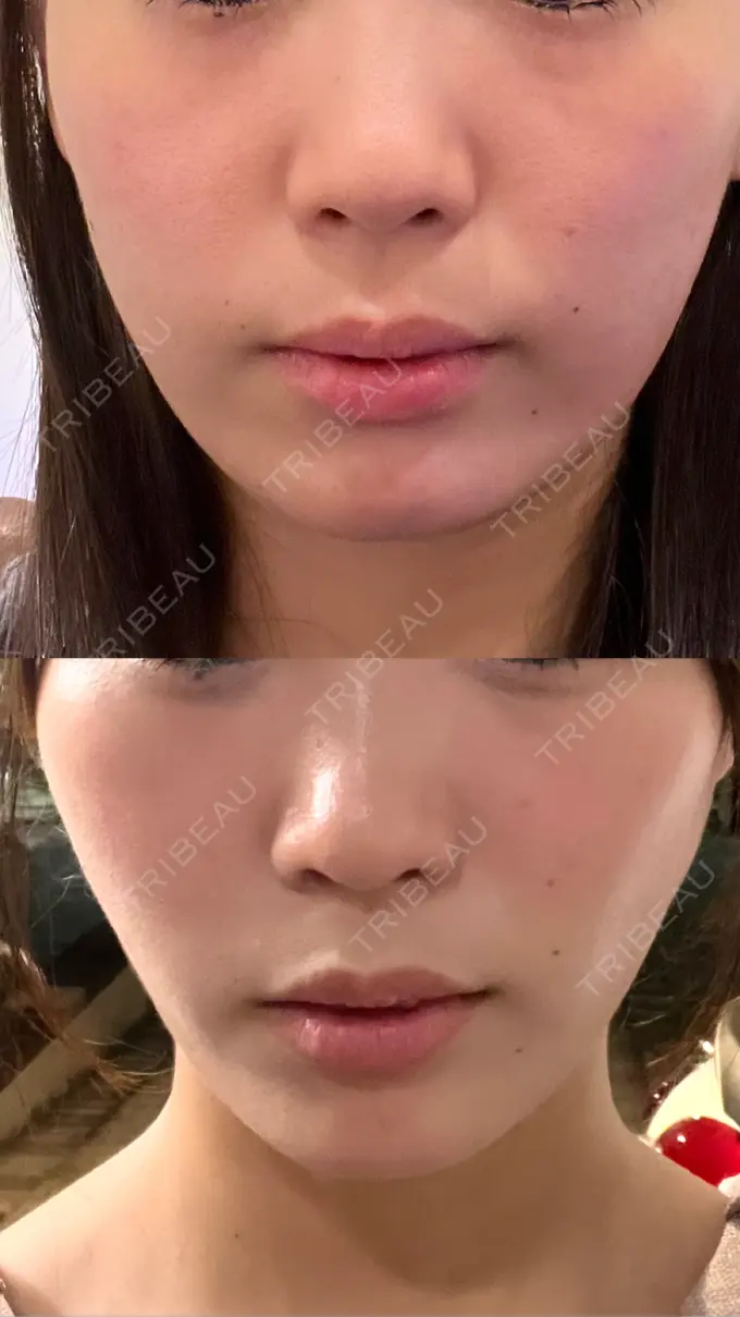 糸リフト / その他（肌） MAクリニック 心斎橋 DAY 4 メイン用