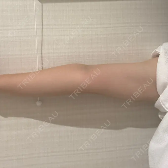 脂肪溶解注射（二の腕） 東京秘密クリニック 渋谷院 DAY 6 メイン用