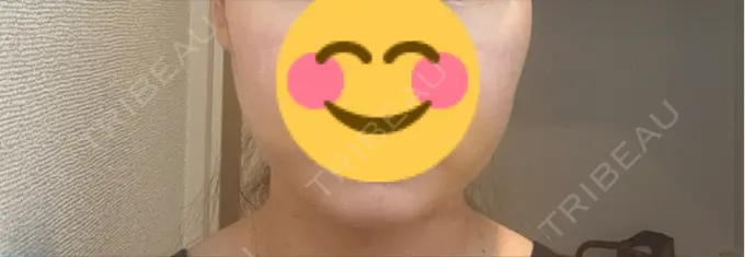 糸リフト / バッカルファット除去 / 脂肪吸引（顔） アリエル美容クリニック 横浜院 DAY 6 メイン用