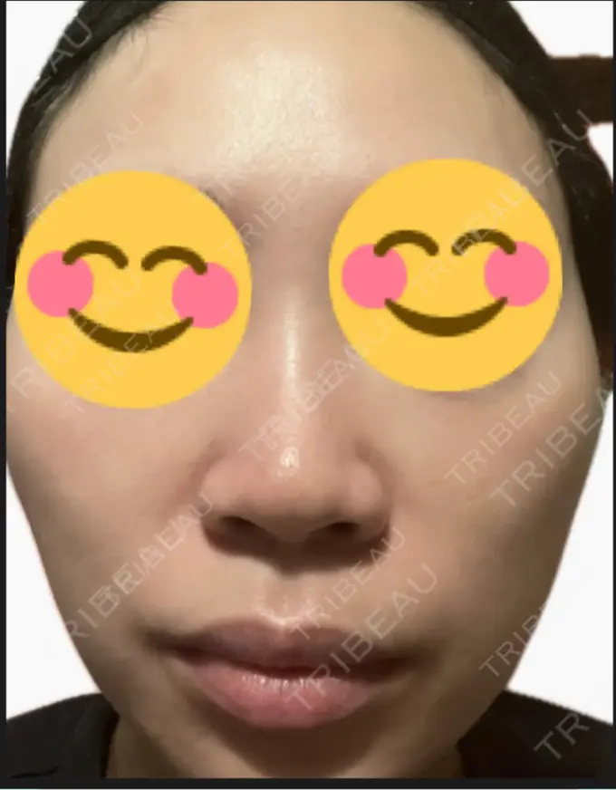 プラセンタ注射 / その他（肌） 美容皮膚科エルムクリニック 麻布院 DAY 5 メイン用