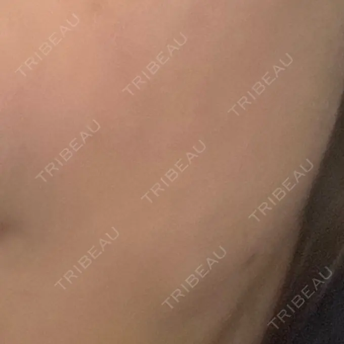 糸リフト / 脂肪吸引（顔） / ジョールファット除去 / 脂肪吸引注射（顔） ziz CLINIC AFTER メイン用