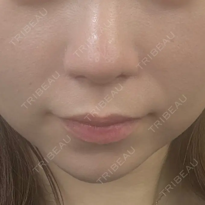 鼻尖形成（切開） / 小鼻縮小（切開） / 軟骨移植 / 鼻尖縮小 ASTRA BEAUTY CLINIC AFTER メイン用