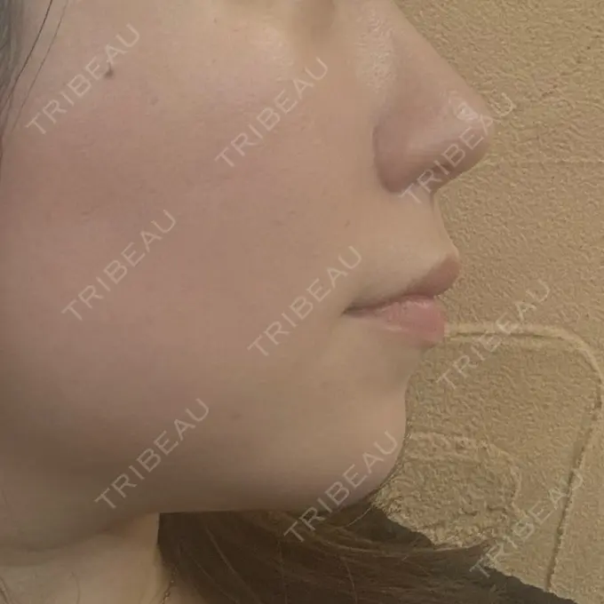 鼻尖形成（切開） / 小鼻縮小（切開） / 軟骨移植 / 鼻尖縮小 ASTRA BEAUTY CLINIC DAY 72 メイン用