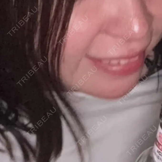 ヒアルロン酸注入（あご） ルラ美容クリニック 渋谷本院 DAY 35 メイン用