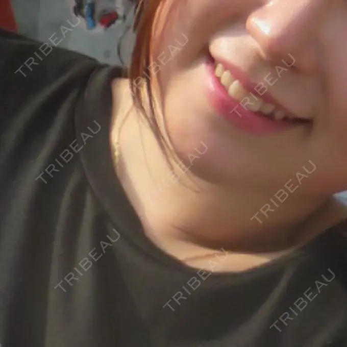 ヒアルロン酸注入（あご） ルラ美容クリニック 渋谷本院 AFTER メイン用