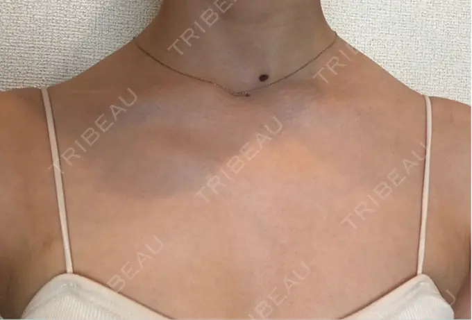 ボトックス（肩） ルラ美容クリニック 静岡院 DAY 5 メイン用