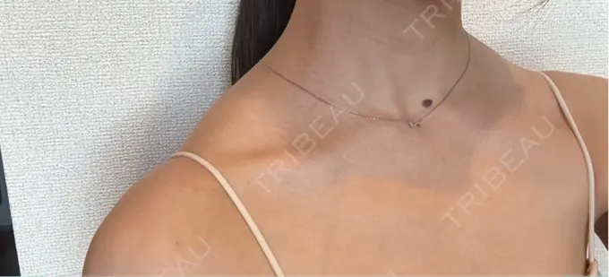 ボトックス（肩） ルラ美容クリニック 静岡院 DAY 5 メイン用