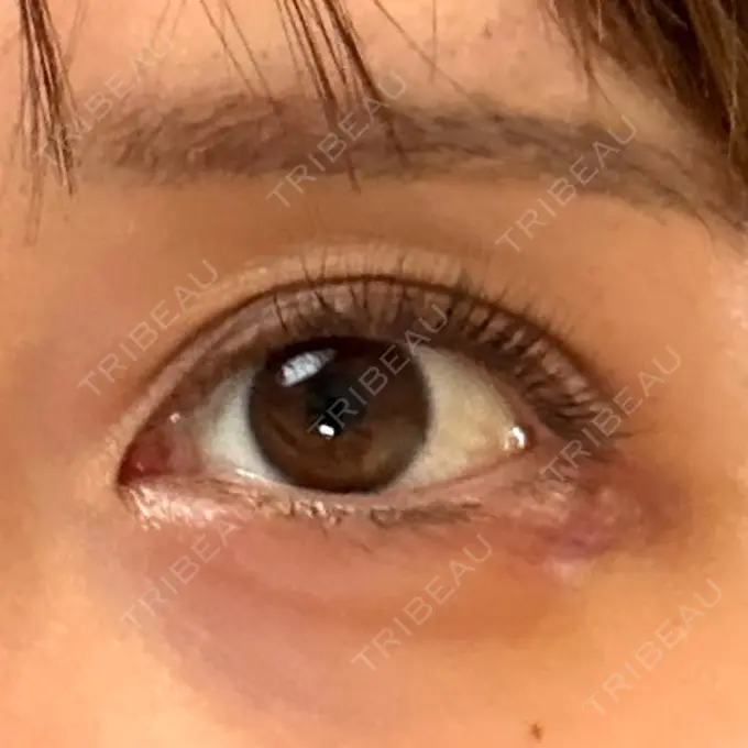 ヒアルロン酸注入（涙袋） アリエル美容クリニック 横浜院 DAY 3 メイン用