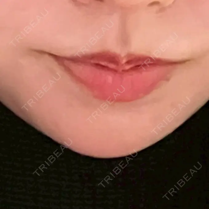 ボトックス（あご） / ボトックス（口角） / シワ取りボトックス LE CLINIC AFTER メイン用