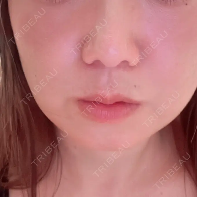 ボトックス（エラ・小顔） ビューティー和心クリニック 浅草院 DAY 4 メイン用