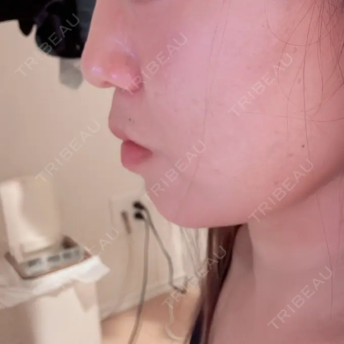 ボトックス（エラ・小顔） ビューティー和心クリニック 浅草院 DAY 4 メイン用