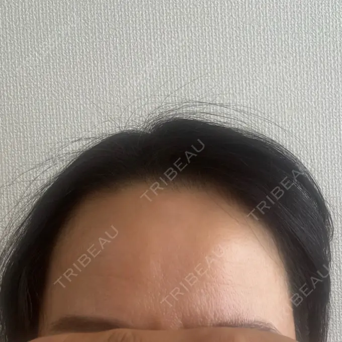 ボトックス（額） LIBER CLINIC DAY 0 メイン用