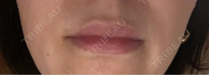 ヒアルロン酸注入（唇） / ヒアルロン酸注入（目の下） アリエル美容クリニック 横浜院 DAY 4 メイン用