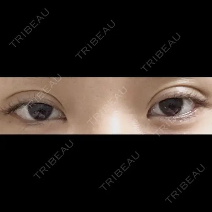 二重埋没 ドクター松井クリニック 新宿 DAY 2 メイン用