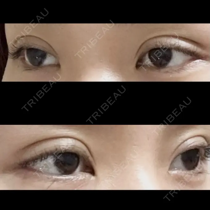 二重埋没 ドクター松井クリニック 新宿 DAY 2 メイン用