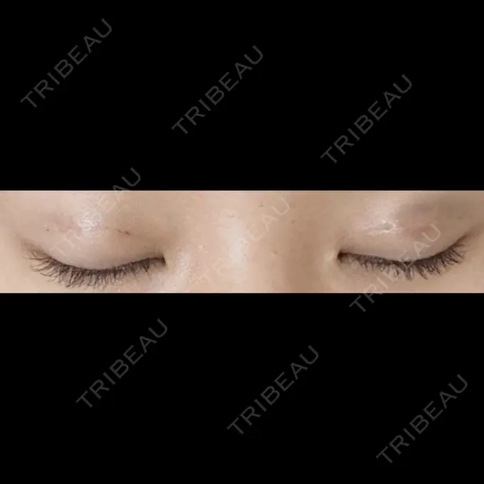 二重埋没 ドクター松井クリニック 新宿 DAY 2 メイン用