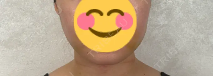 糸リフト / バッカルファット除去 / 脂肪吸引（顔） アリエル美容クリニック 横浜院 DAY 7 メイン用