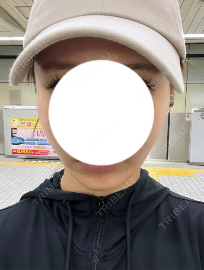 糸リフト / その他（肌） MAクリニック 心斎橋 DAY 5 メイン用