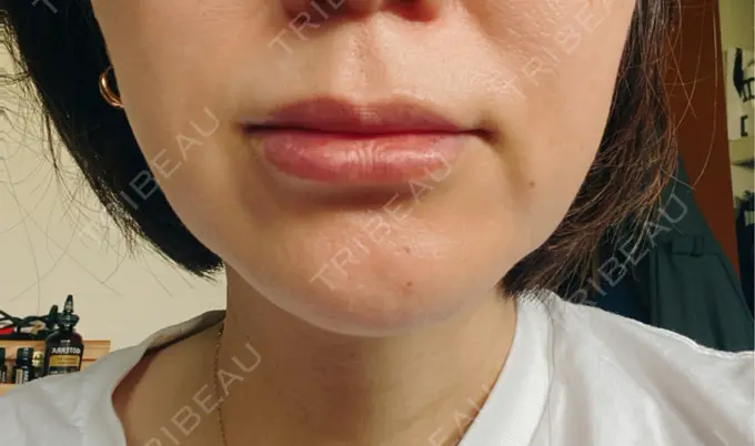 ヒアルロン酸注入（唇） / ヒアルロン酸注入（目の下） アリエル美容クリニック 横浜院 DAY 5 メイン用