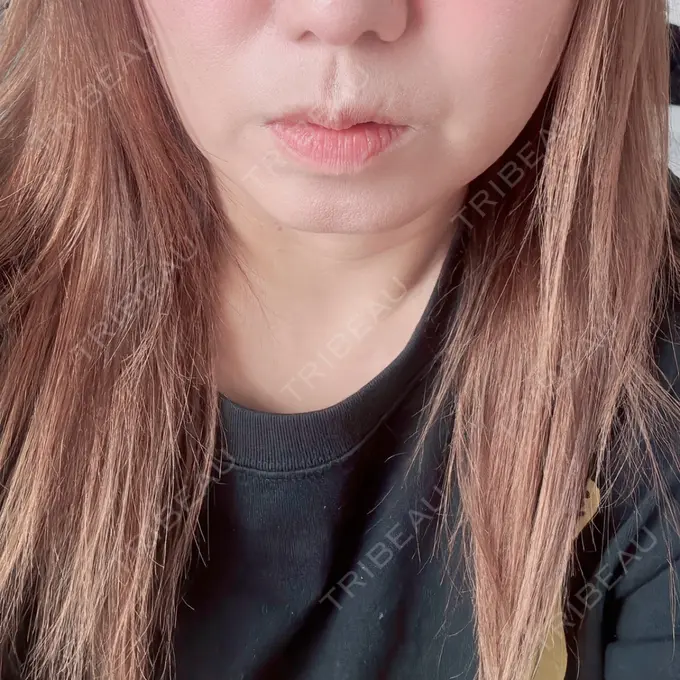 ボトックス（エラ・小顔） ビューティー和心クリニック 浅草院 AFTER メイン用