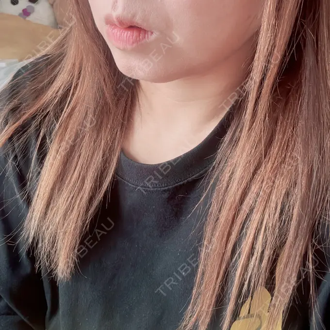 ボトックス（エラ・小顔） ビューティー和心クリニック 浅草院 DAY 5 メイン用