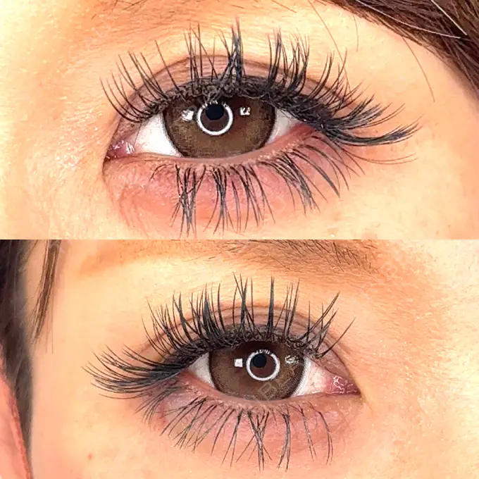 ヒアルロン酸注入（涙袋） / ヒアルロン酸注入（唇） アリエル美容クリニック 横浜院 DAY 0 メイン用